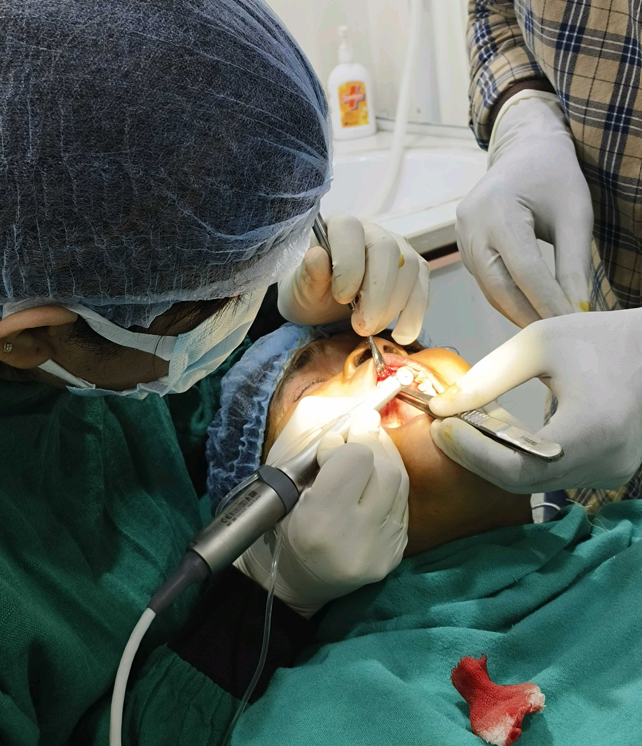 Dental RCT in Varanasi