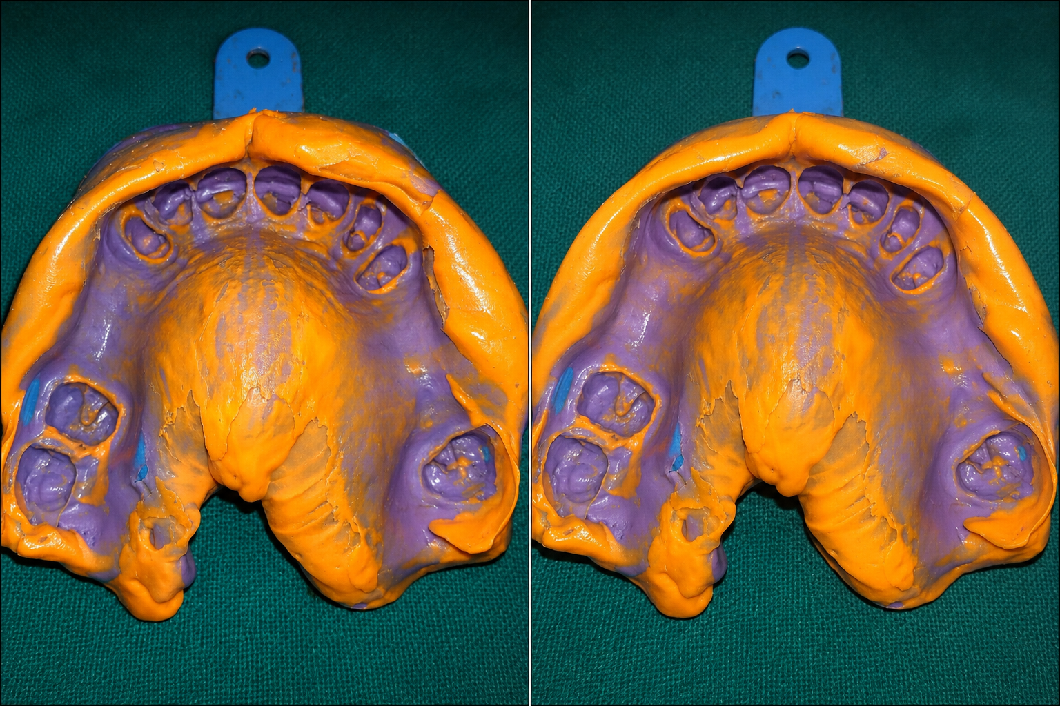 Dental Implants in Varanasi