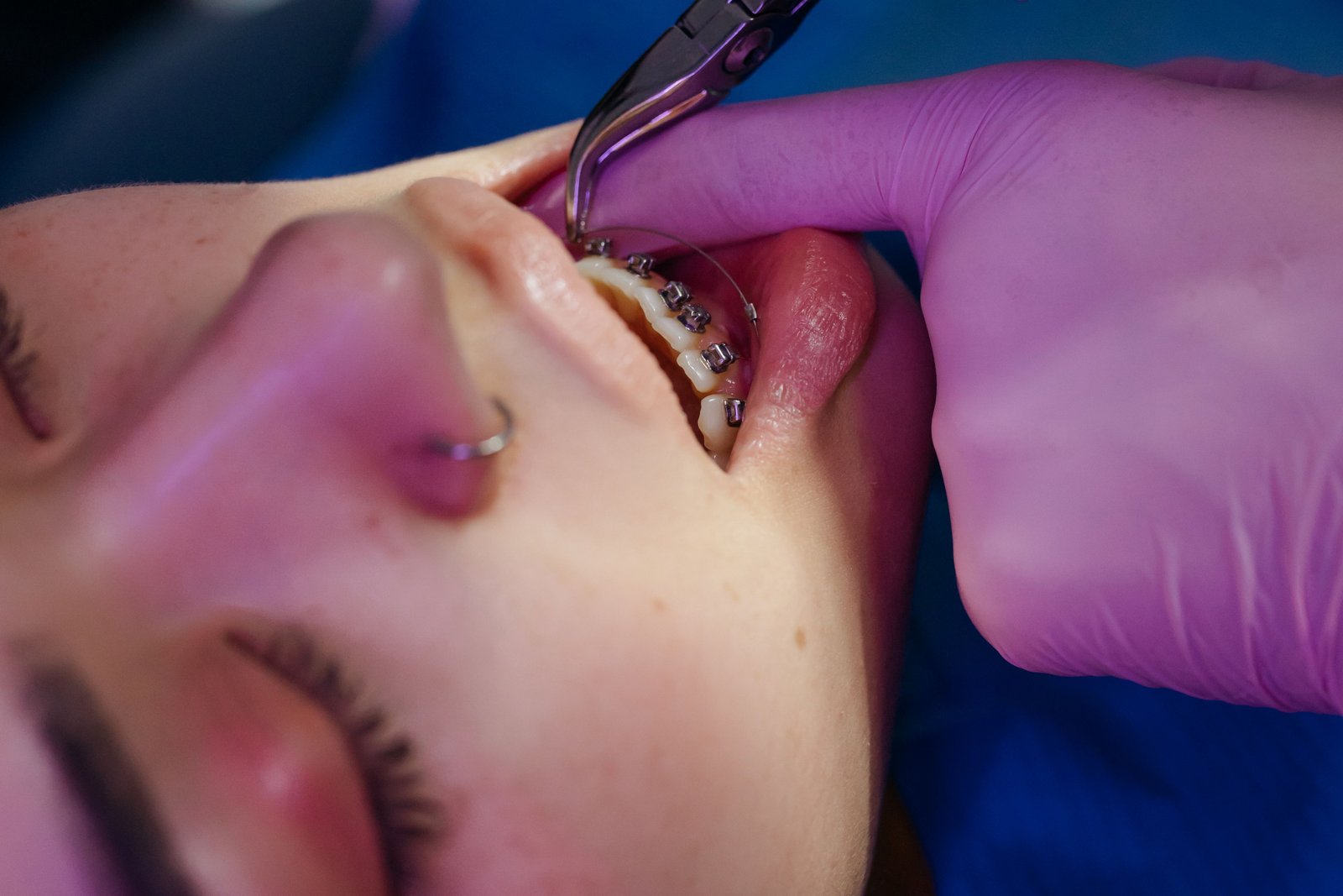 Clinical imagery of intermaxillary fixation and jaw wiring