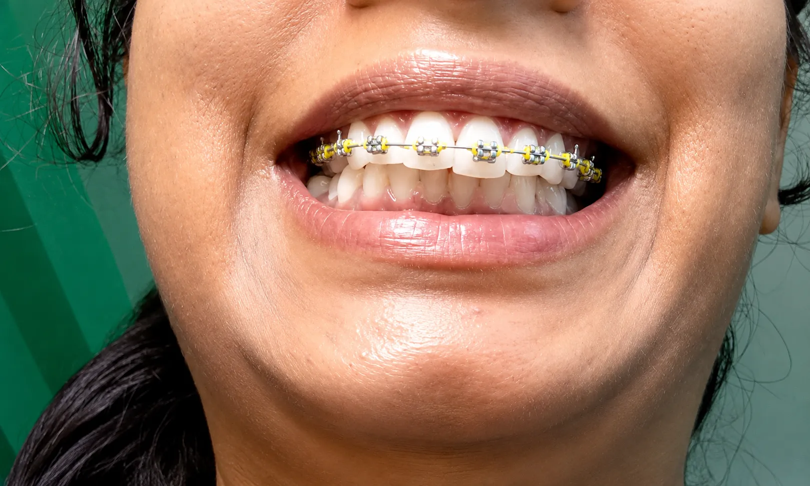 Metal Braces