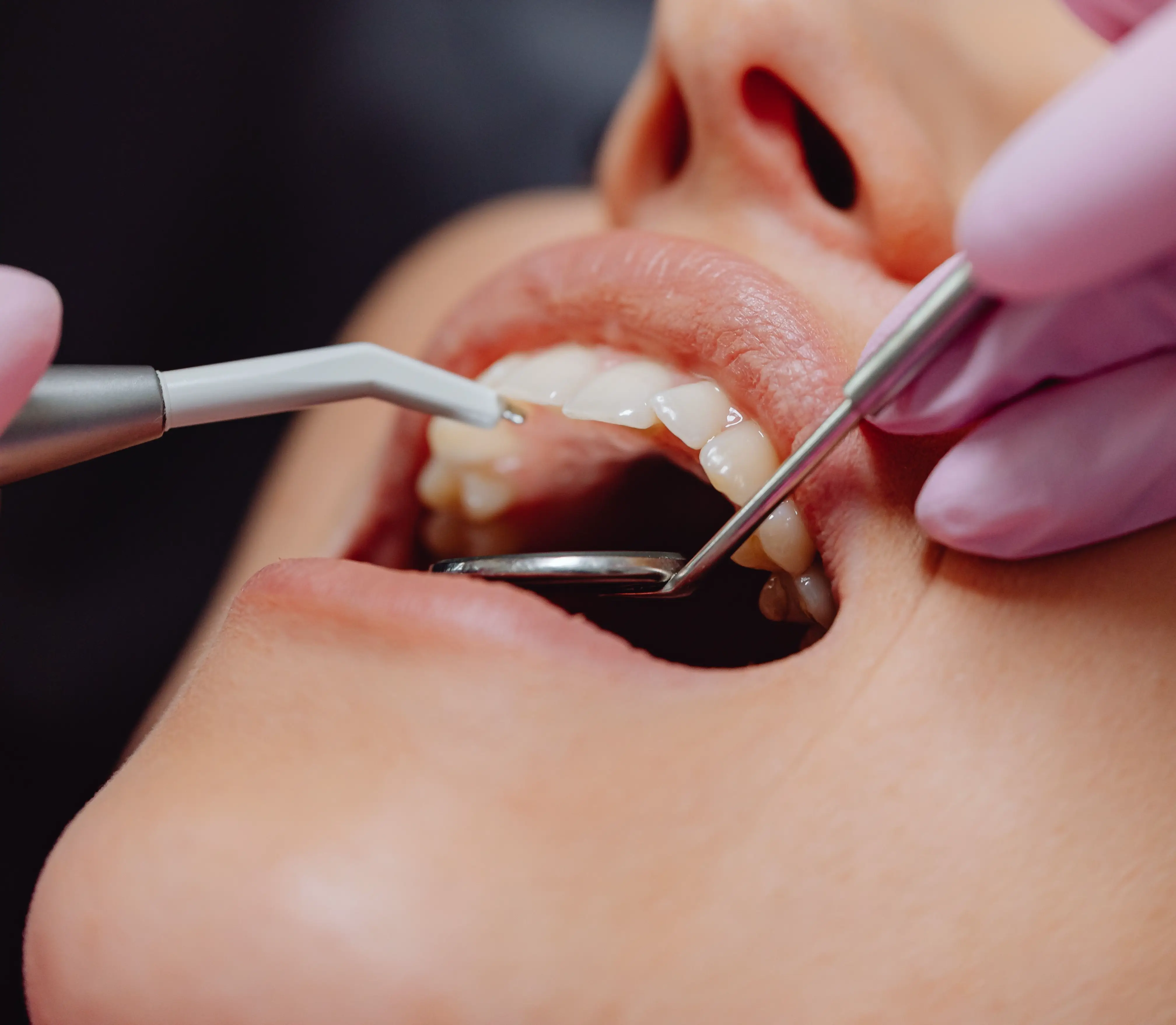 Full Mouth Rehab