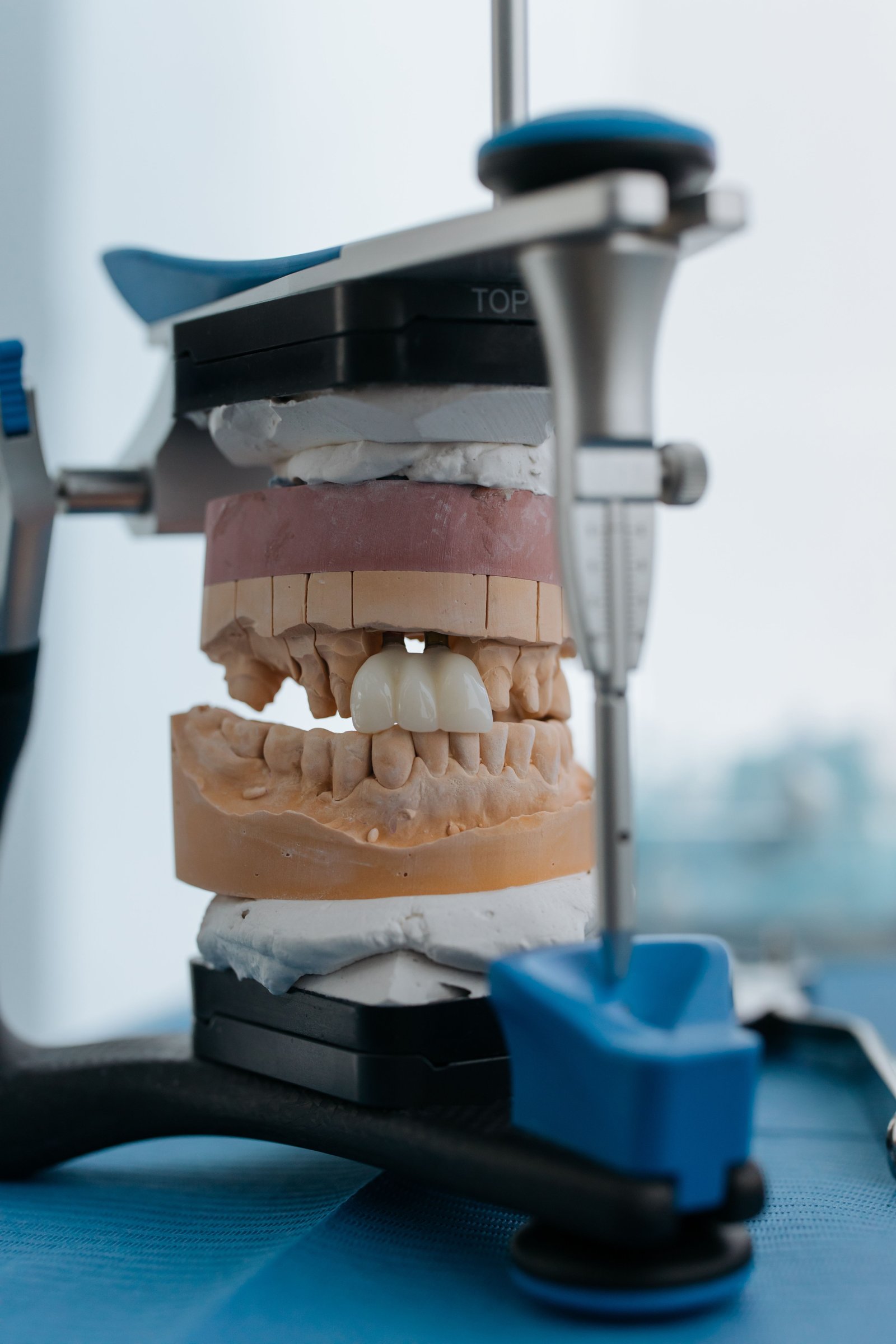Dental Crowns and Bridges in Varanasi