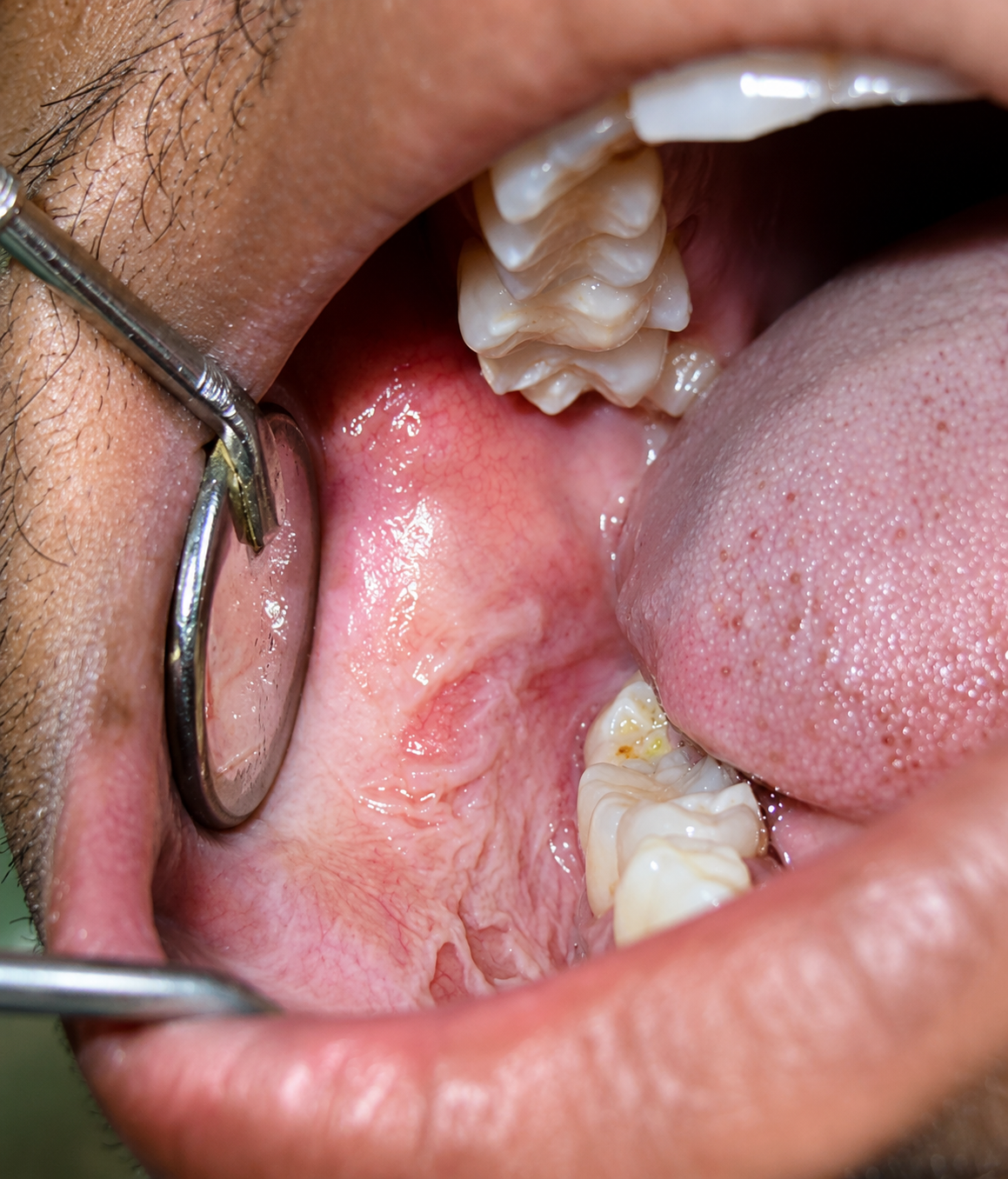 Leukoplakia Treatment in Varanasi