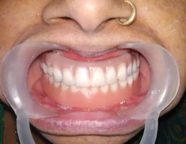 Dentures