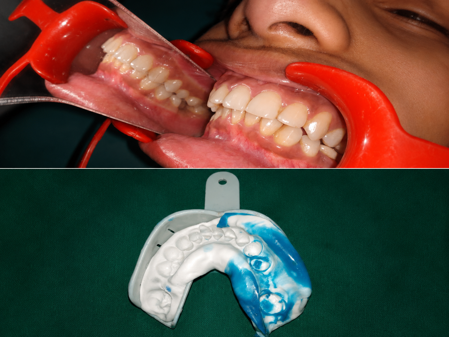 Dentures in Varanasi