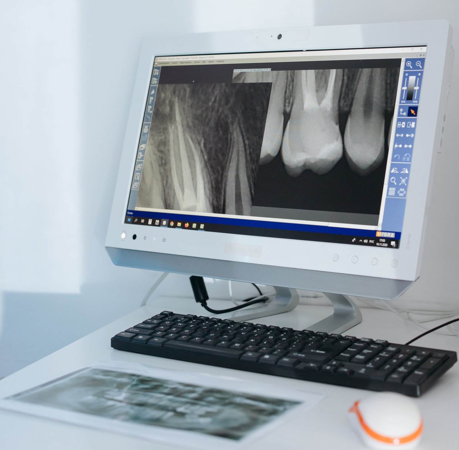 Radiographic view of a failed root canal requiring retreatment
