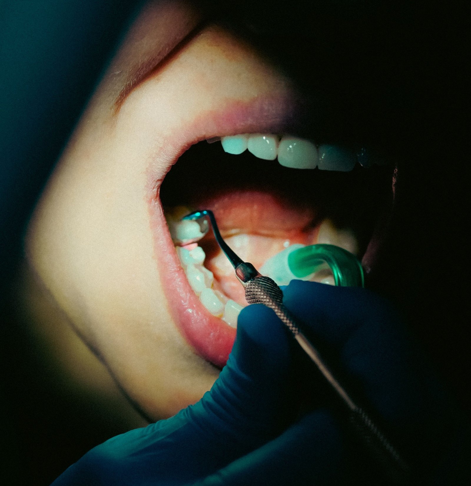 Close up of a tooth-colored composite filling being applied