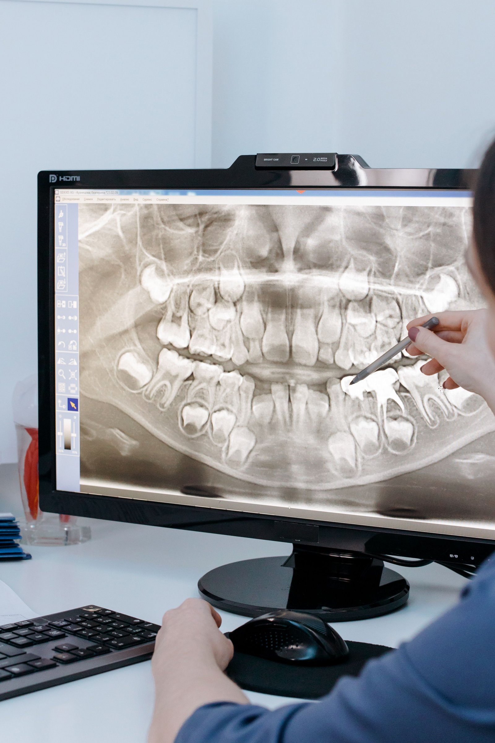 Dental Fractures Cure in Varanasi