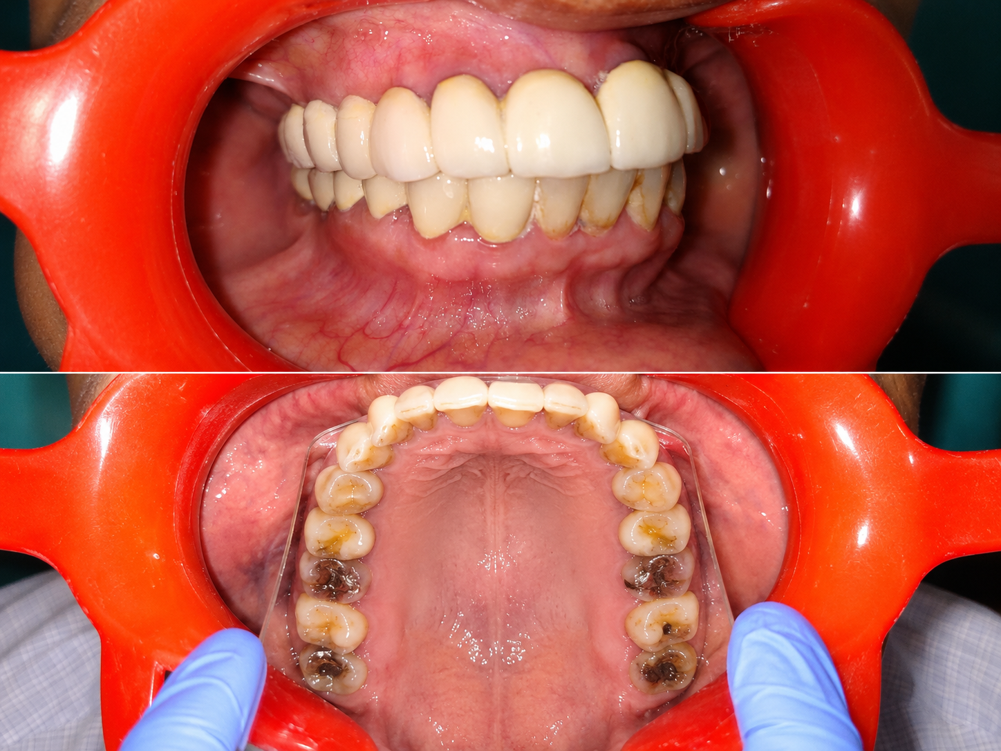 Full-mouth Rehabilitation in Varanasi