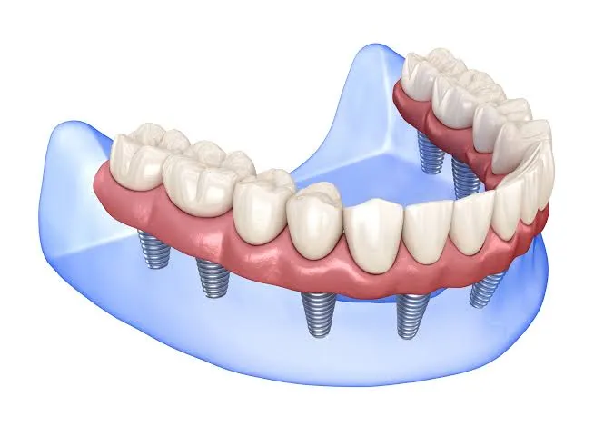 Dental Implants in Varanasi