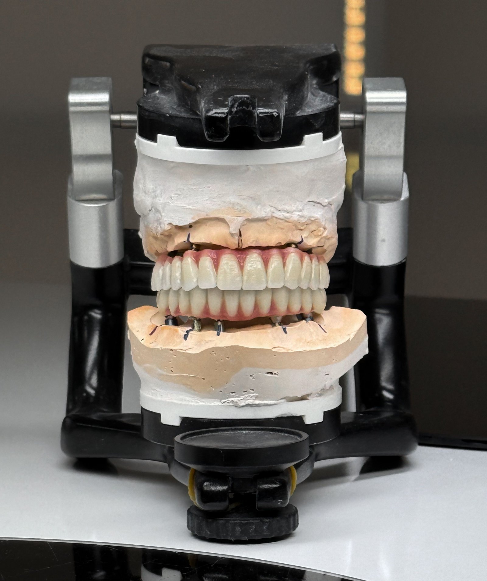 Clinical imagery of a hybrid dental prosthesis