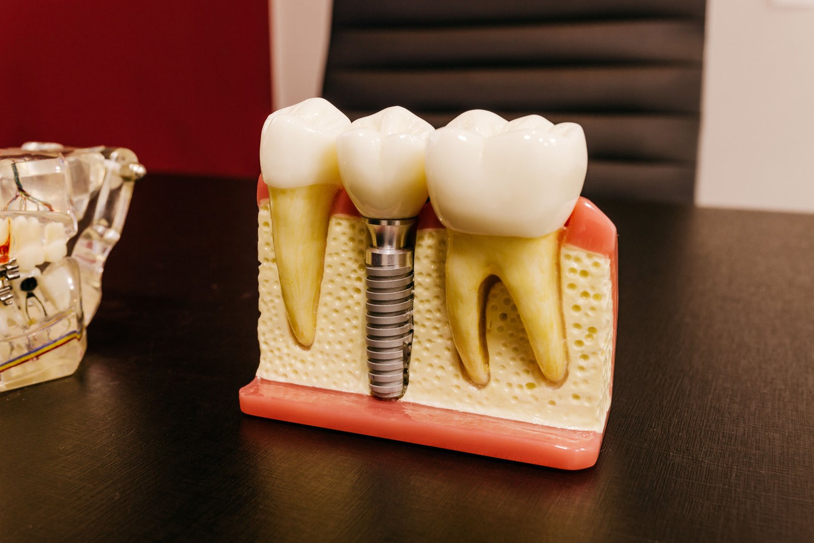 Dental Implants in Varanasi