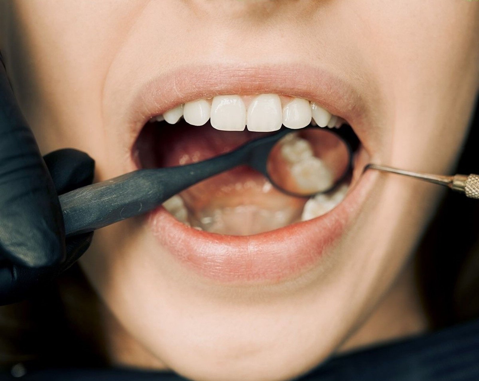 Clinical presentation of Oral Submucous Fibrosis