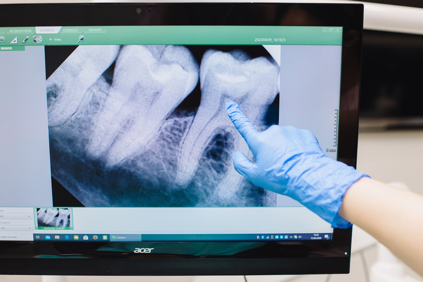 Clinical imagery of a root canal procedure