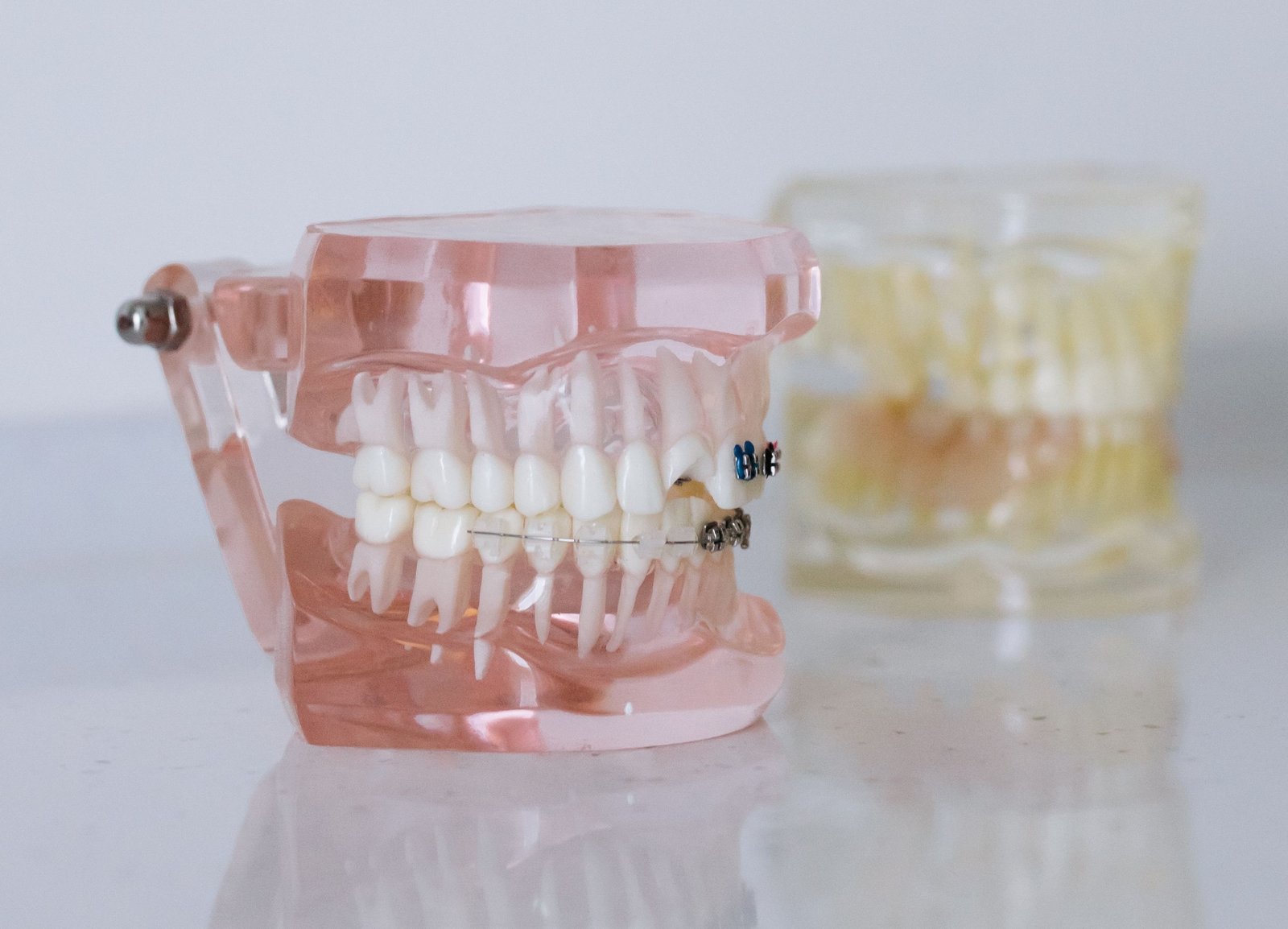 Removable Braces in Varanasi