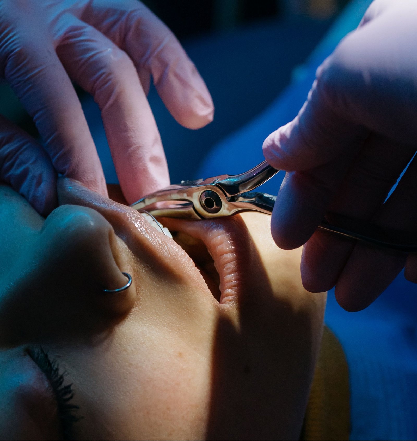 surgical tooth extraction in Varanasi